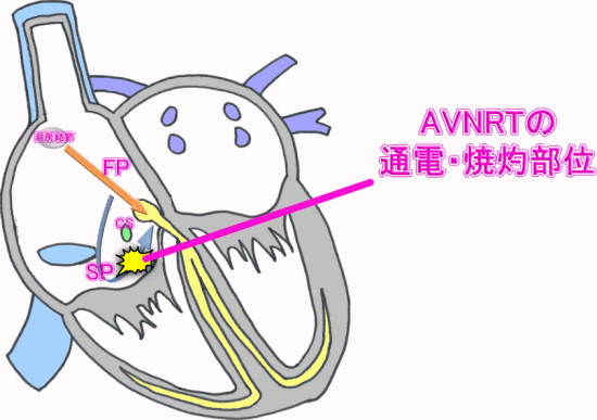 アブレーション　AVNRT　通電・焼灼部位