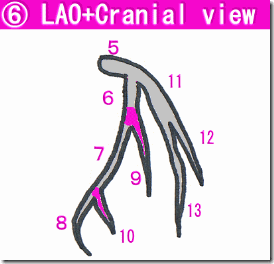 冠動脈造影（CAG) lao cranial