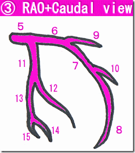 冠動脈造影（CAG) rao caudal